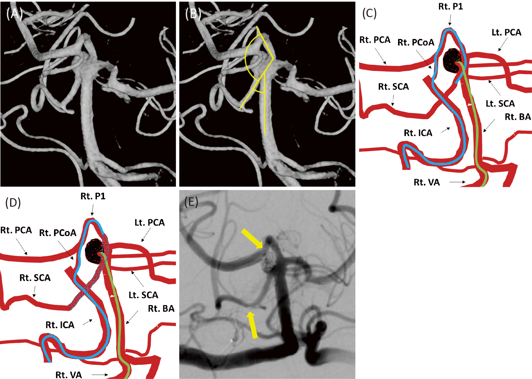 Stentassisted Coil Embolization Using a Transcirculation Technique for